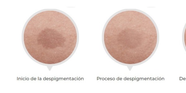 Protege tu piel del sol y previene las manchas: Tipos de melasma y lentigo